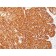 Melanoma Marker(HMB45 + M2-7C10 + M2-9E3 + T311), 1mg/mL