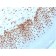 Nucleophosmin (Acute Myeloid Leukemia Marker)(NPM1/3398), 1mg/mL